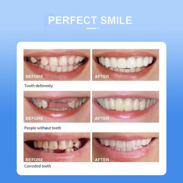 Snap-on Smile For Beautiful Smiles